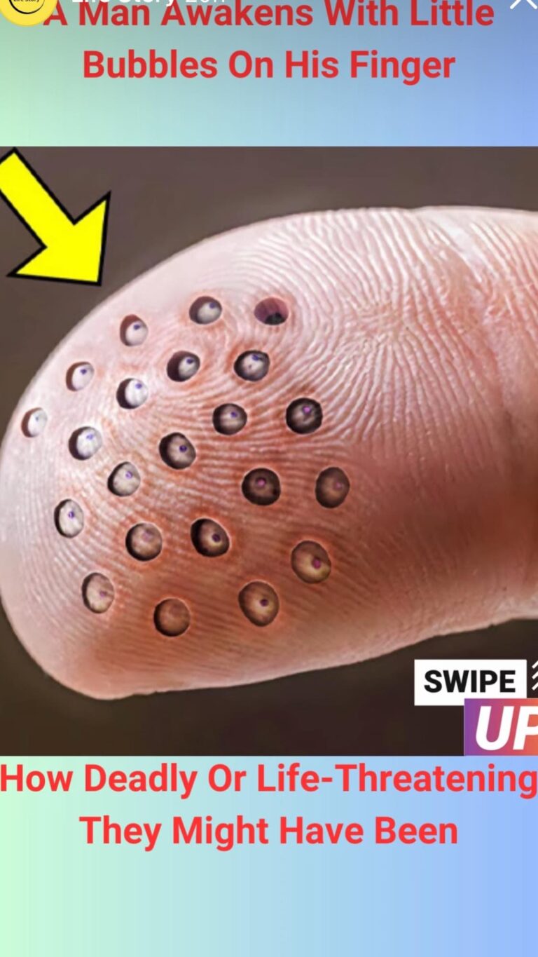 A man awakens with little bubbles on his finger