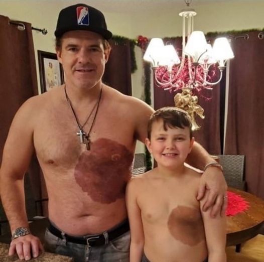 Dad Gets Matching Birthmark Tattoo to Show His Son That Being ‘Different’ Can Be Cool