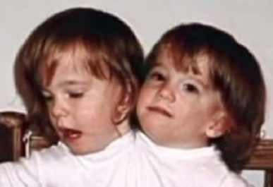These conjoined Hensel twins are adults now and here is what they look like today…