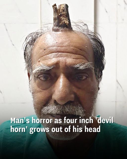 Man Gets Bumped And Grows 4-Inch Devil Horn From His Head