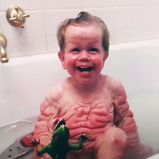 In 1993, this boy was born with enough skin for a five-year-old. But when we look at him today it is difficult not to shed a tear