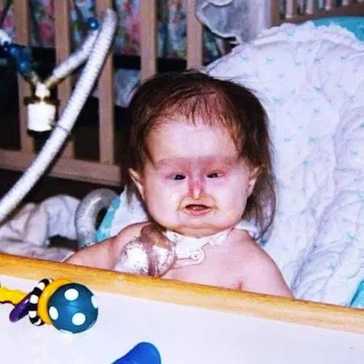 Unusual Syndrome at Birth: 22 Years Later,