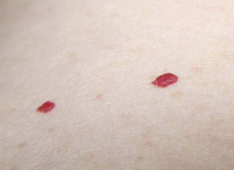 If You Spot These Red Dots On Your Skin