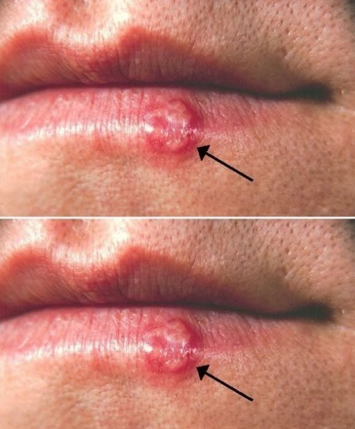 Most People Carry This Cold Sore Virus, But Few Know How to Treat It – Here’s What You Should Do!