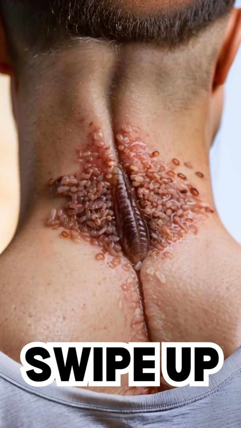 Acne occurs when hair follicles become clogged.