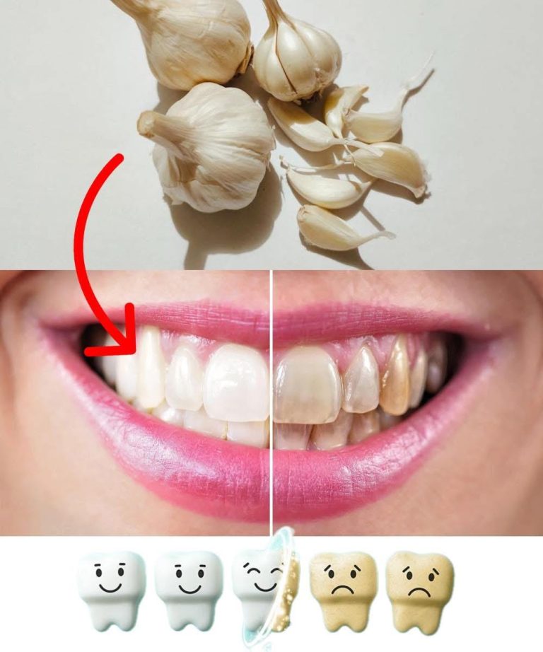 Improve Your Oral Health Naturally with Garlic