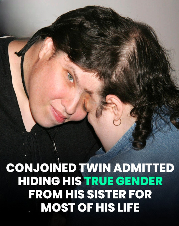 Conjoined Twin Who Came Out As Transgender Confessed He ‘Kept Desire Hidden’ From Sister For Decades