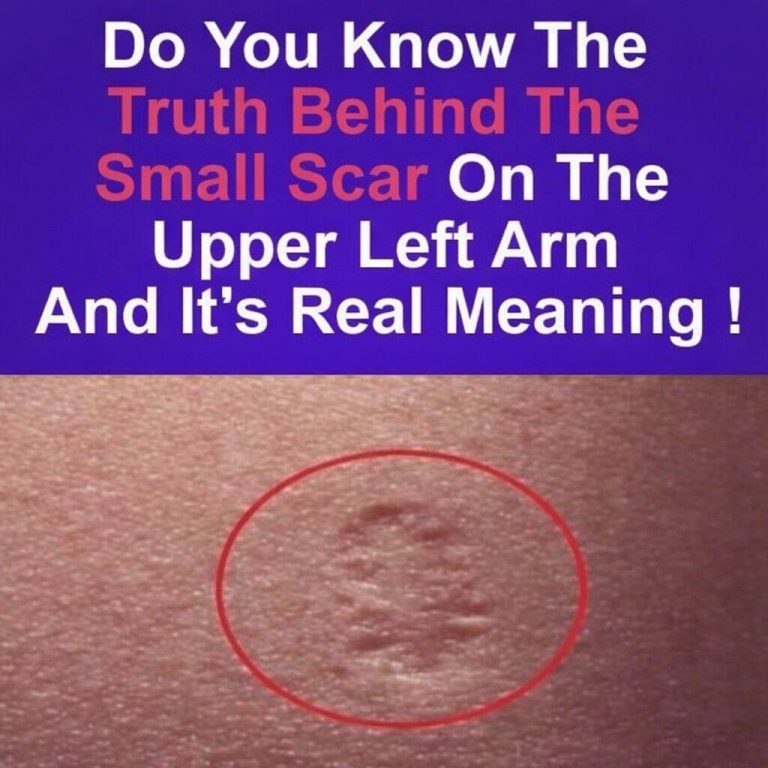 Smallpox vaccine scars: What they look like and why